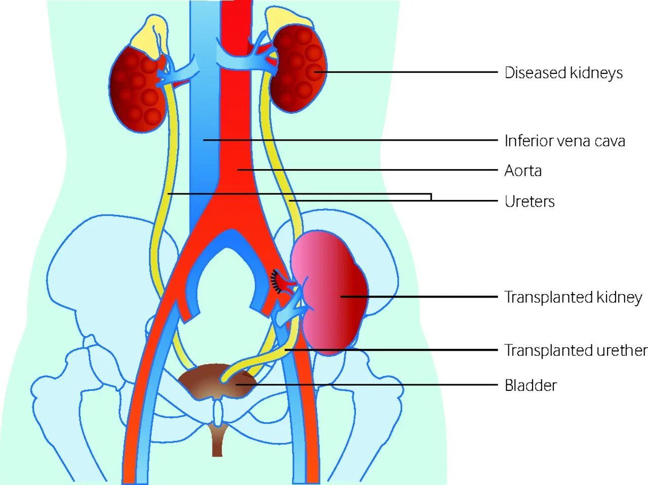 trasplante renal