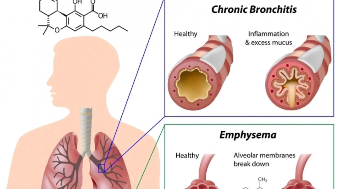 obstructive pulmonary disease