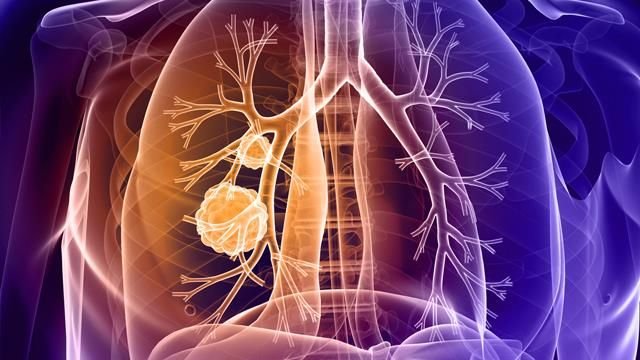 LUNG CANCER