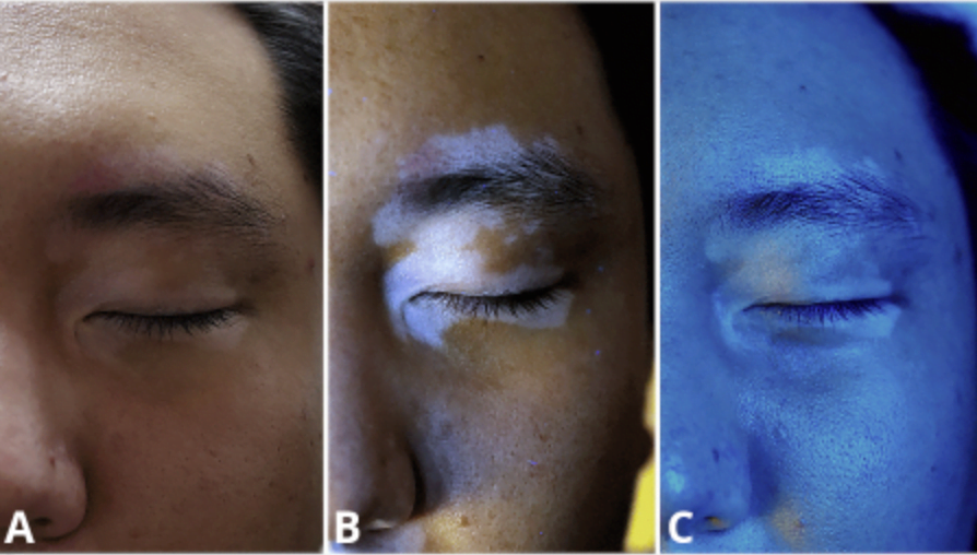 Vitiligo diagnosis