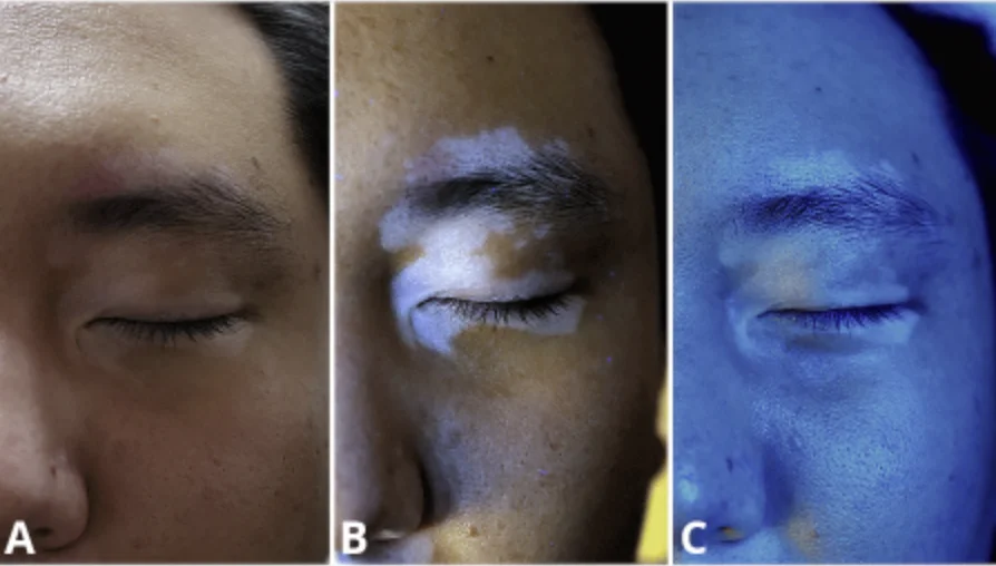 Vitiligo diagnosis