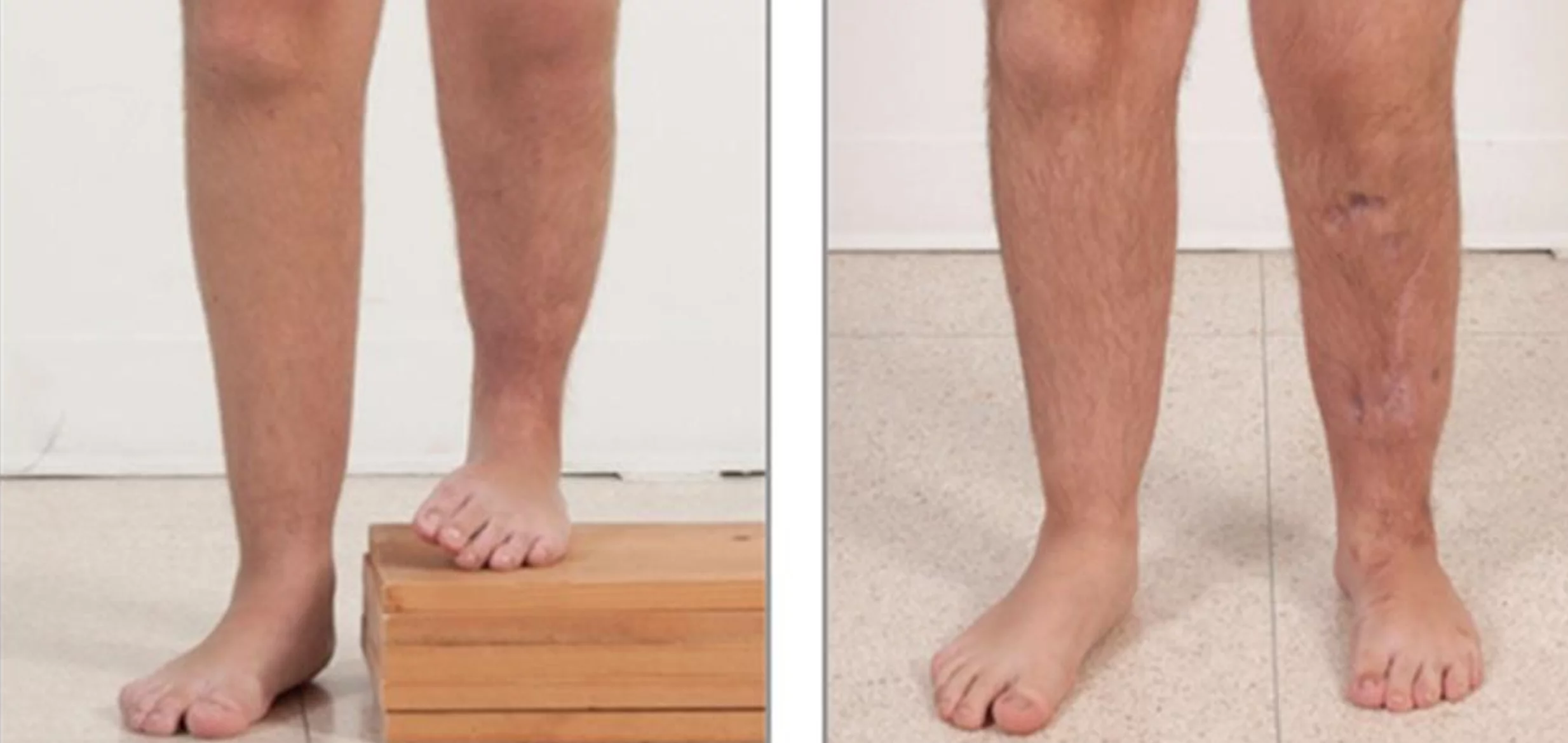 Elongation Shinbones Surgery