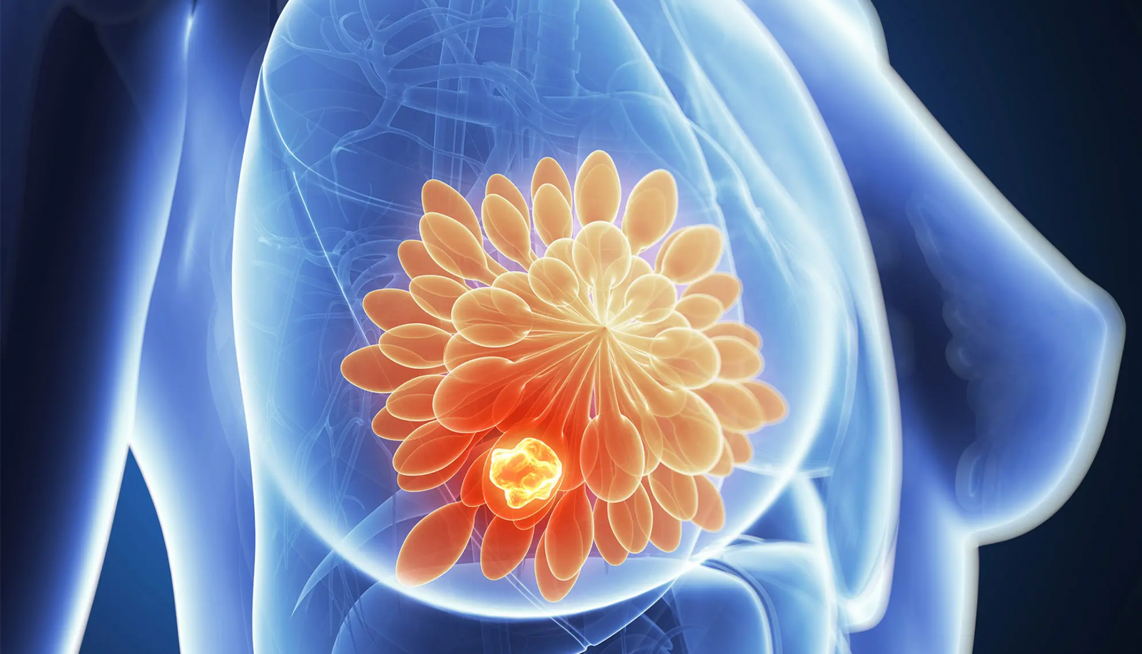 Cáncer de mama