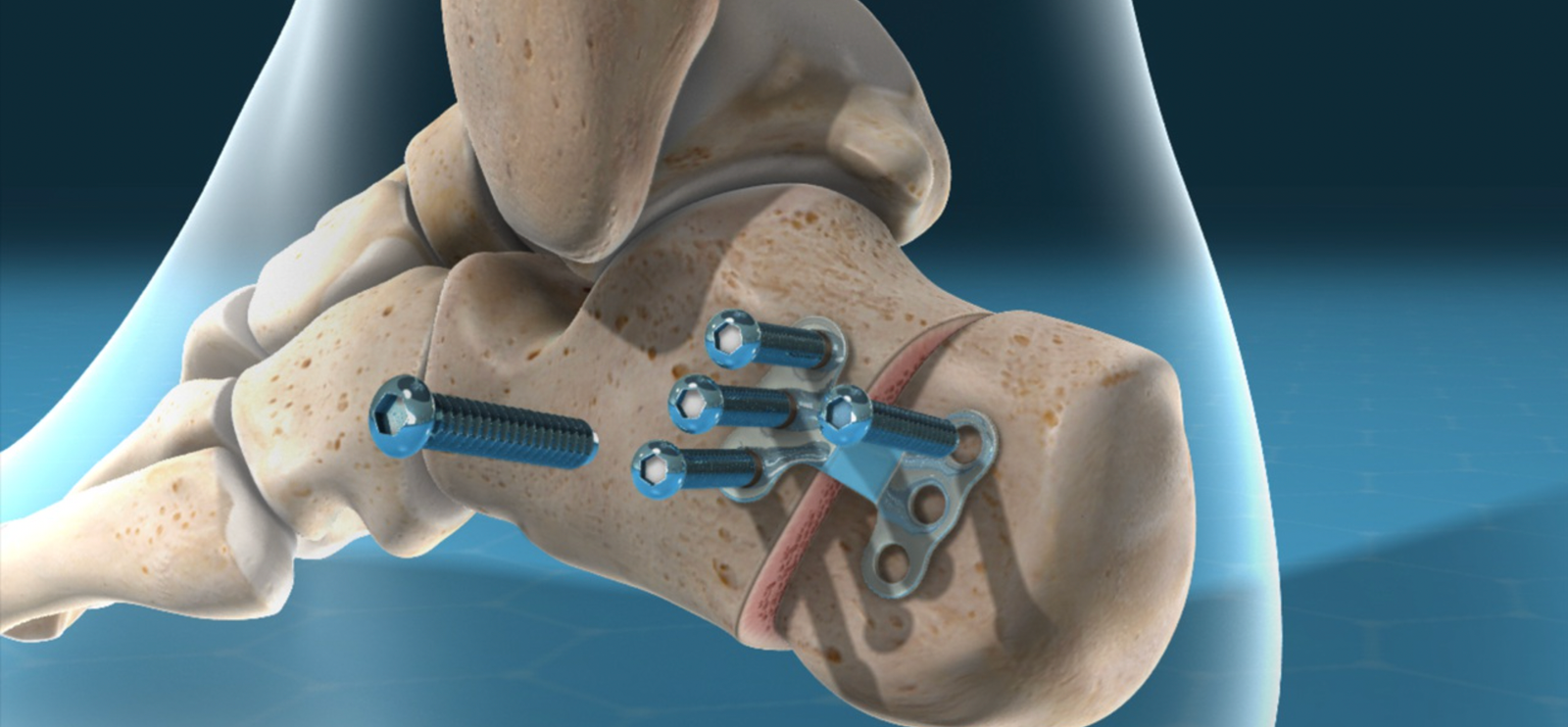 CALCANEAL THERAPEUTIC