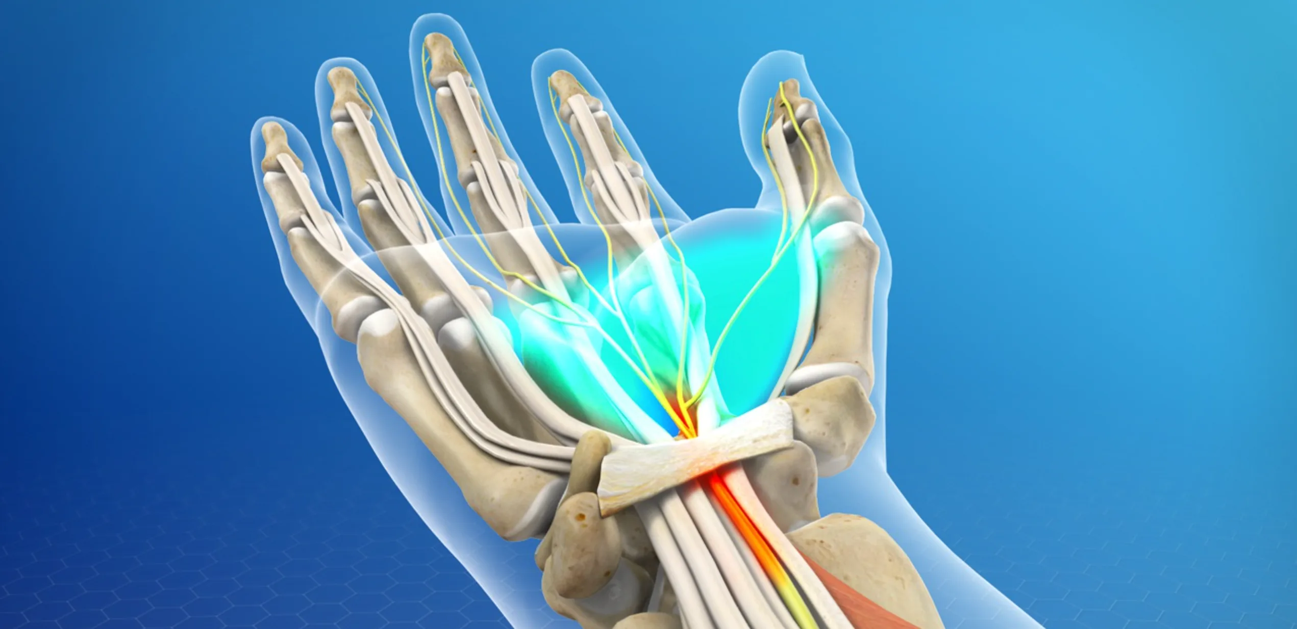 Carpal Tunnel Syndrome