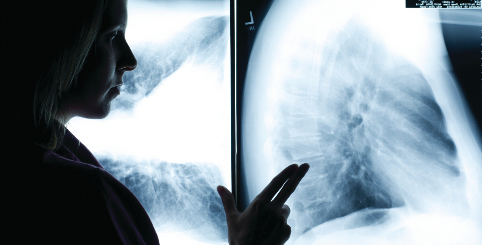 Cáncer de Pulmón