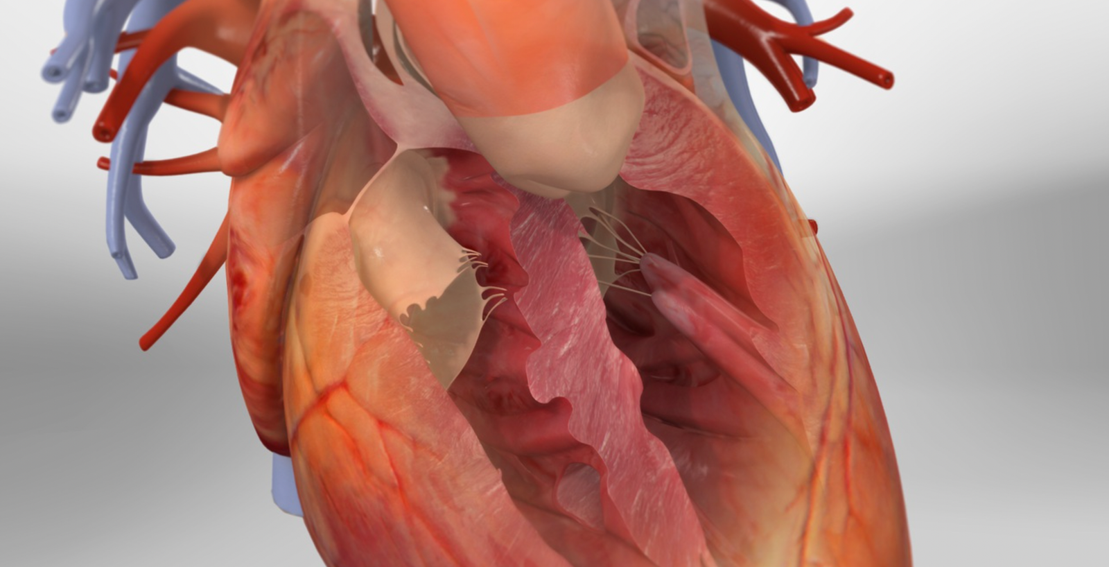 Tetralogy of Fallot