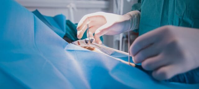 Fistula Surgical Removal